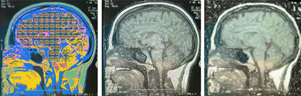 MRI scans