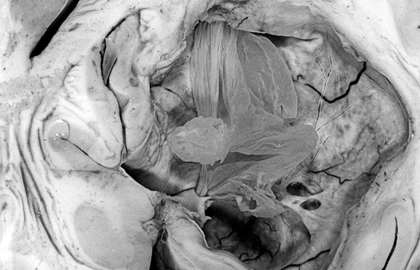 Cysticercosis