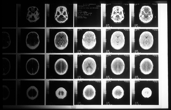 photo of CAT scans on a lightbox